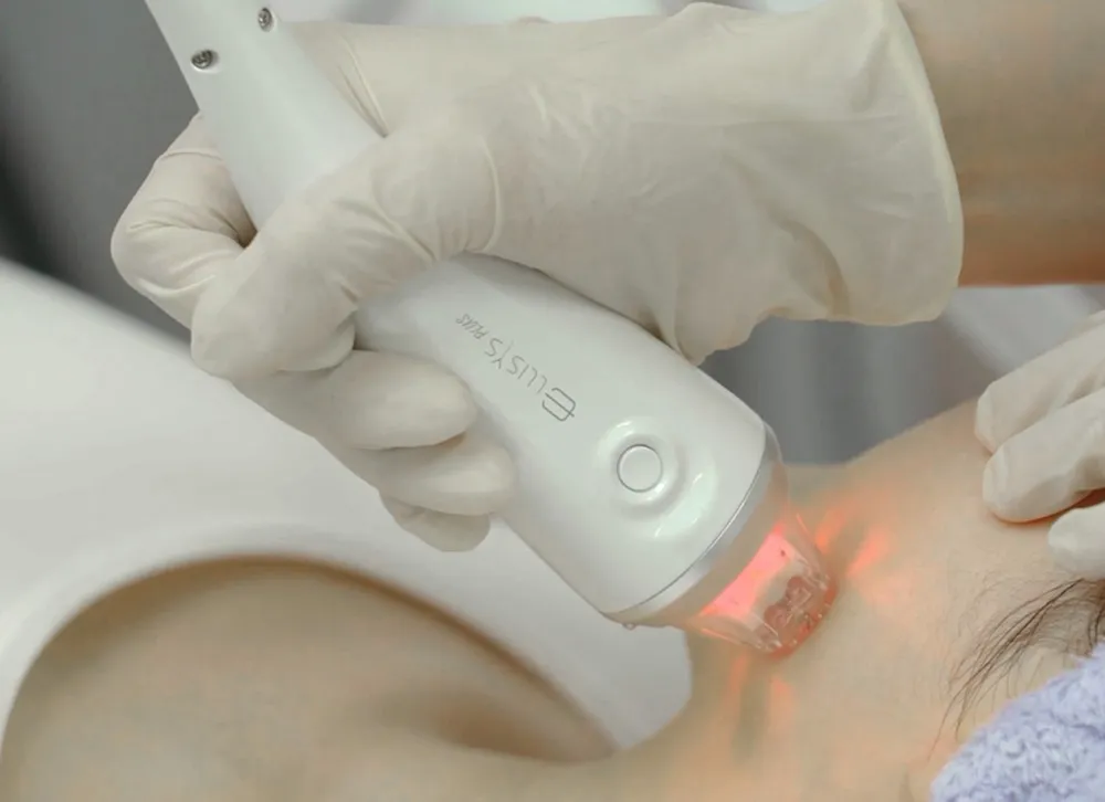 RF-Microneedling