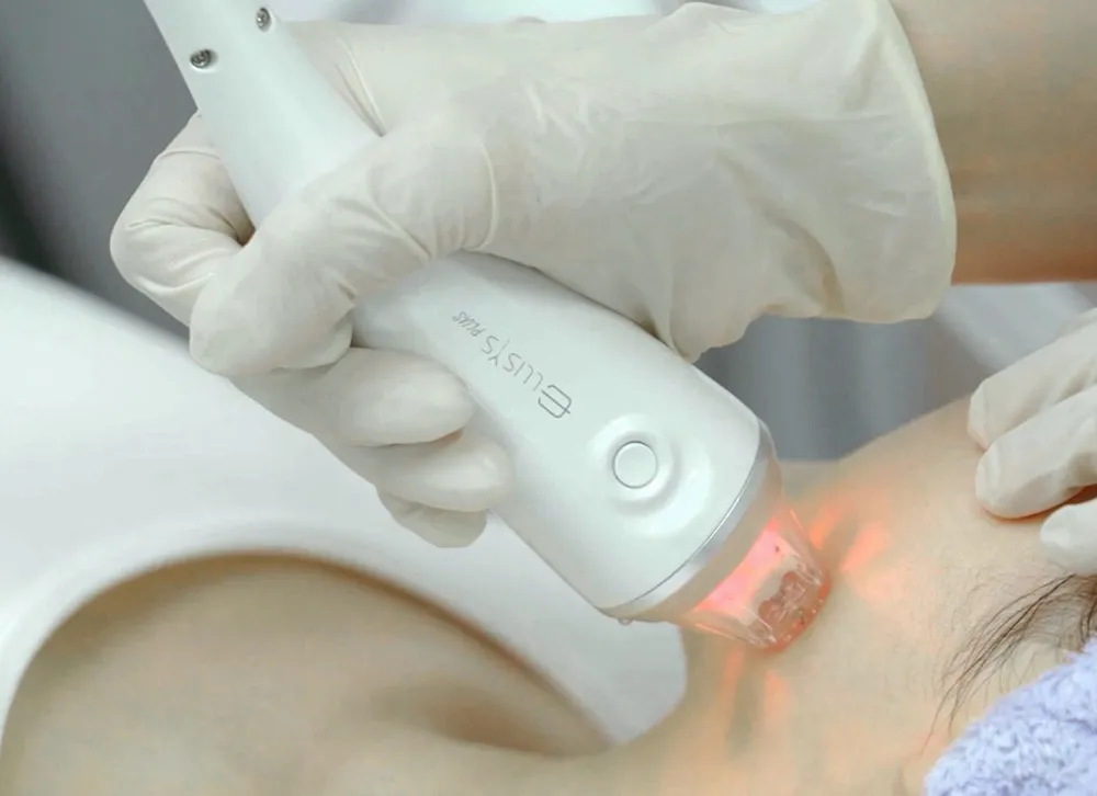 ELLISYS-System für RF-Microneedling bei Ana Wimmer Medical Aesthetics München